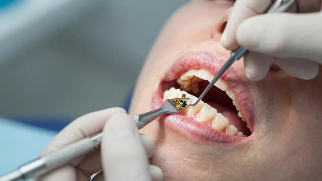 Kyretáž zubů: Jak pomáhá při parodontóze a co od ní čekat