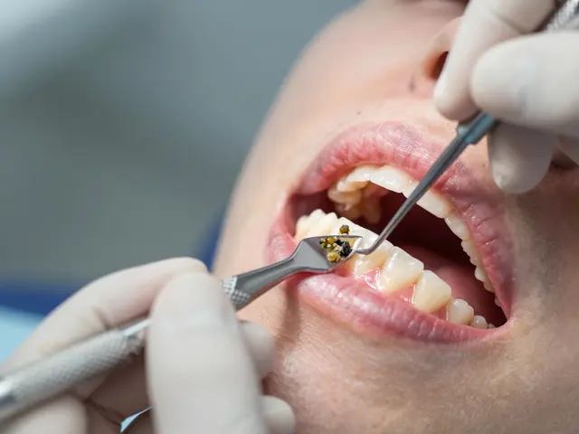 Kyretáž zubů: Jak pomáhá při parodontóze a co od ní čekat