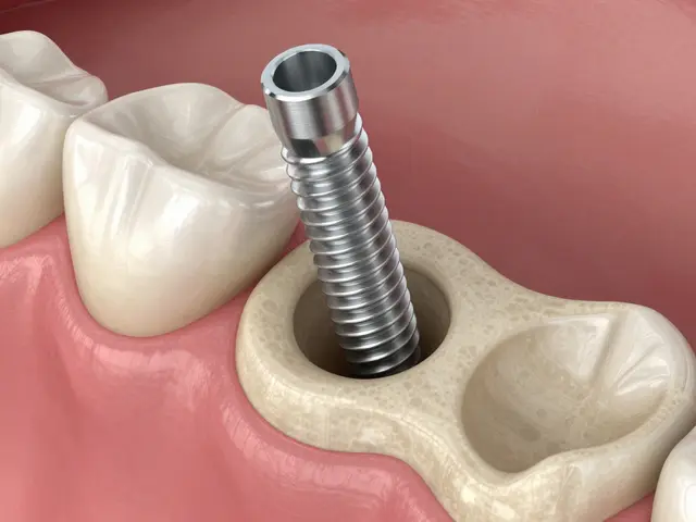 Proč jsou zubní implantáty stále populárnější? Příčiny růstu poptávky a výhody